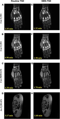 High-Resolution Simultaneous Multi-Slice Accelerated Turbo Spin-Echo Musculoskeletal Imaging: A Head-to-Head Comparison With Routine Turbo Spin-Echo Imaging
